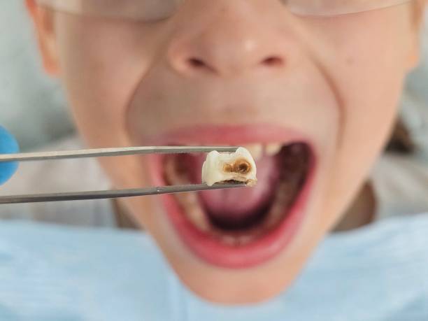 Best Emergency Dental Care for Broken or Chipped Teeth in Lincoln Beach, OR